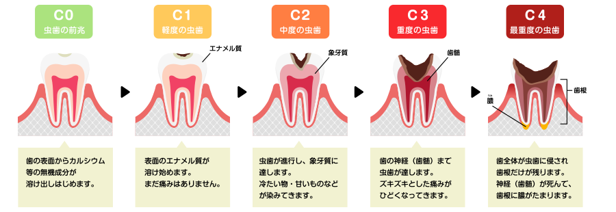 虫歯の進行