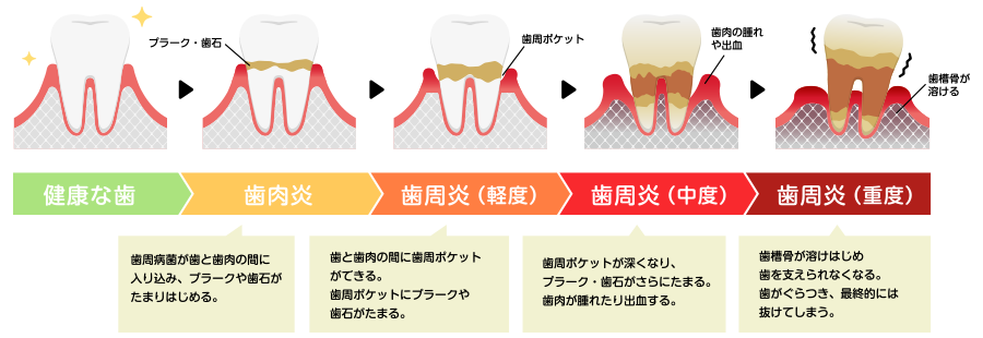 歯周病の進行