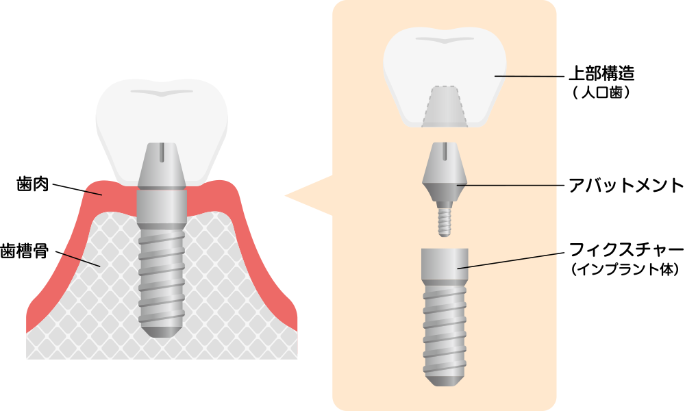 インプラントの構造