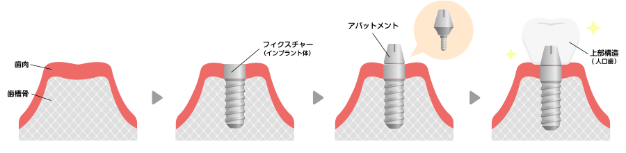 インプラントの治療の流れ